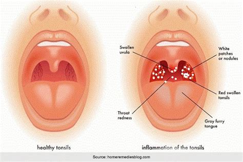 Top 4 Causes And Treatments For White Spots On The Throat