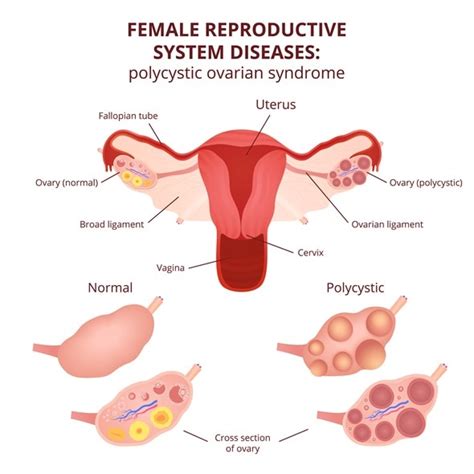 Information in this subreddit should not be a substitute for obtaining. Polycystic Ovary Syndrome Treatment