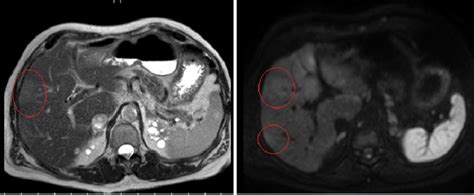 Magnetic Resonance Imaging Scan Of Abdomen With And Without Contrast