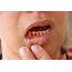 Bleeding Gums Causes Dos And Donts Treatment  Fitness