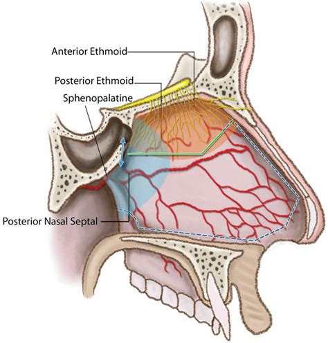 Lateral View Of The Nasal Septum Depicting The Mucosal Cut Made For