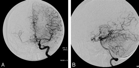 Anterior Ethmoidal Artery Aneurysm And Intracerebral Hemorrhage
