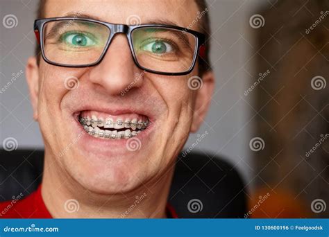 Curved Teeth Of Guy With Braces In Glasses Close Up Portrait Of Stock