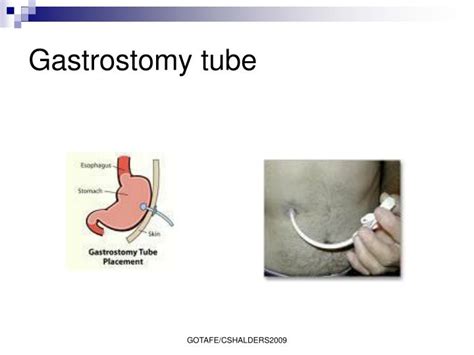 Ppt Gastrostomy Powerpoint Presentation Id1711546