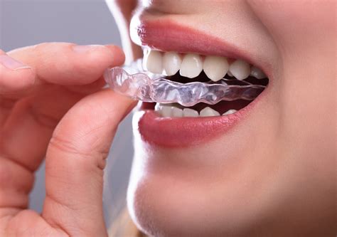 Clear Teeth Braces Carrollton Tx Benefits Of Invisalign