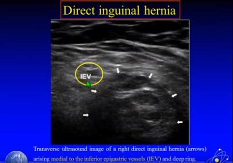 Direct And Indirect Hernia Inguinal Hernia Ahn Indirect Inguinal