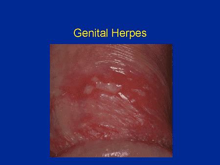 What i am concerned about is how many times will i have to face this. The Diagnosis and Management of Genital Herpes: The Silent ...