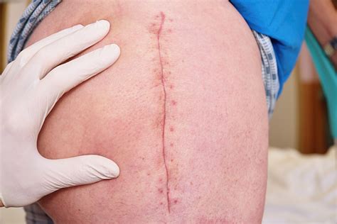 Getting Rid Of Scars Using The Best Scar Cream After Surgery