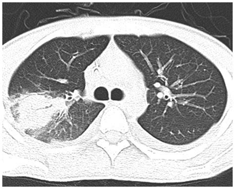 Variedades clínicas de la mucormicosis. Pulmonary mucormycosis: A case report and review of the ...