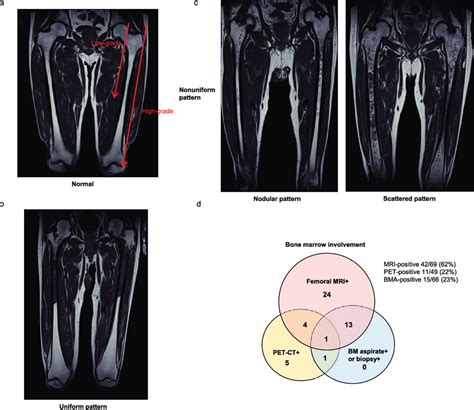 Patterns And Ranges Of Femoral Marrow Mri A Representative Images Of