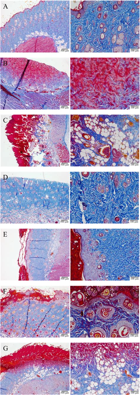 Massons Trichrome Staining Of The Rat Skin After Third Degree Burns