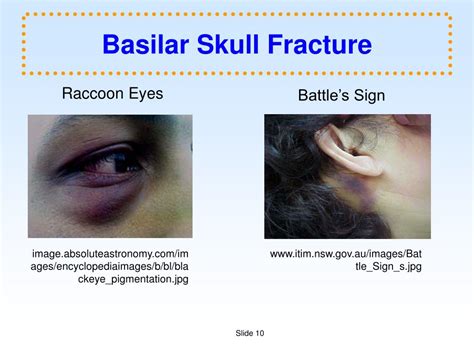 Basilar Skull Fracture Signs