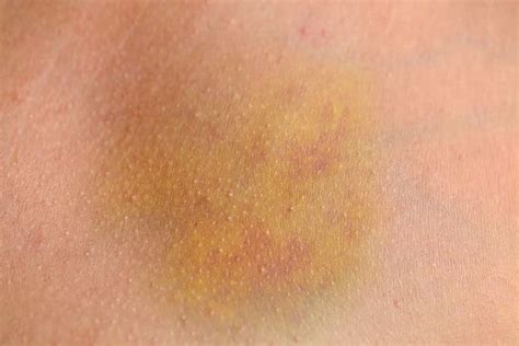 Yellow Spots On Skin Causes And Treatments Skin Care Geeks