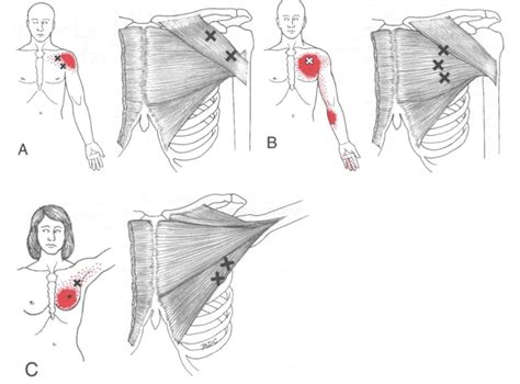 Pectoralis Major Muscle Trigger Points Muscle Pain