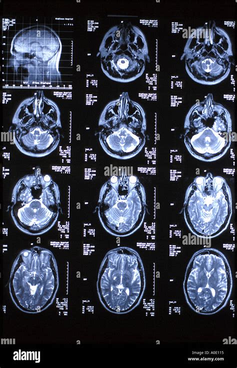 Nuclear Medicine Brain Scan Hi Res Stock Photography And Images Alamy