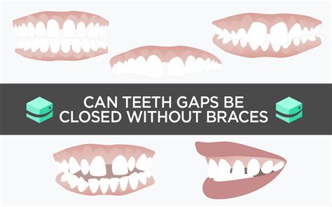 While it is normal for baby teeth to fall out and make way for. Teeth gaps: can they be closed without the use of braces?