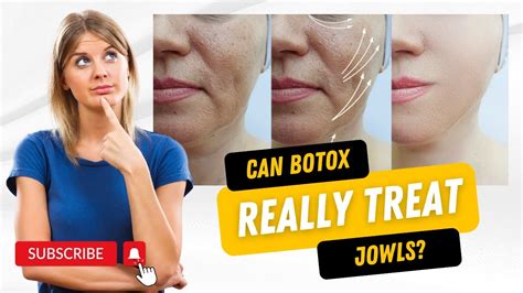 How To Tighten Sagging Skin Botox Treatment For Jowls Xo Medical Spa Youtube