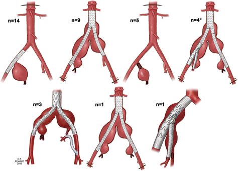 Outcomes Of Open And Endovascular Repair For Ruptured And Nonruptured