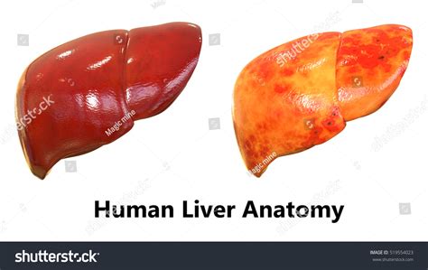 Liver cancer diagram showing details illustration. Human Body Organs Liver Anatomy 3d Stock Illustration 519554023 - Shutterstock
