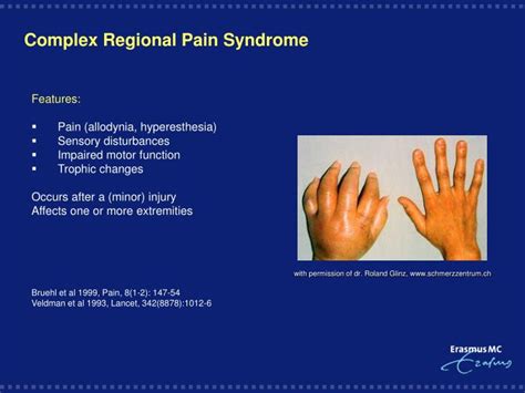 Ppt Complex Regional Pain Syndrome Powerpoint Presentation Free