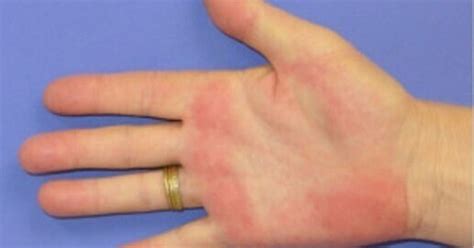 【手掌紅斑】手の平が赤くなるのは何の病気ですか？｜原因不明と戦う総合診療医ドクターp
