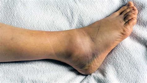 Rotura De Ligamentos Del Tobillo Cu L Es El Tiempo De Recuperaci N