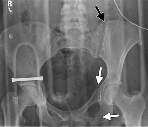 Pelvic Fracture X Ray