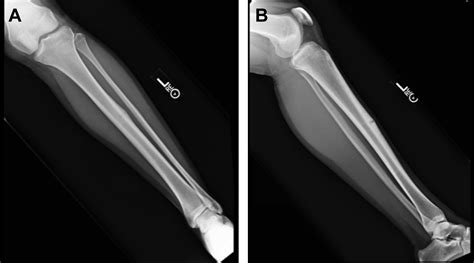 Tibial Stress Fractures In Athletes Orthopedic Clinics