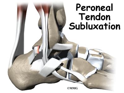 When this tendon damage persists for more than a few weeks, it's called tendinopathy. Peroneal Tendon Subluxation | eOrthopod.com