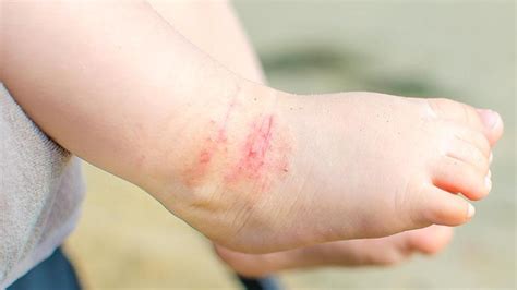 ¿qué Es La Dermatitis Atópica Síntomas Causas Y Cómo Tratar La