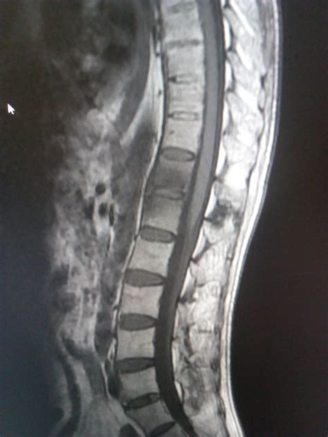 Ankylosing Spondylitis Mri Sumers Radiology Blog