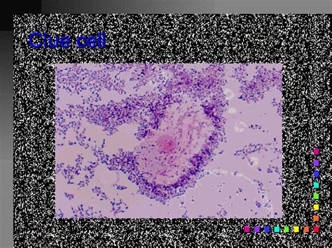 Clue Cell Bacterial Vaginosisgardnerella Vaginalis Flickr
