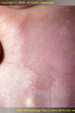 Maybe you would like to learn more about one of these? Ringworm Look Alikes / Help. What does this look like to you? - BabyCenter / What else looks ...
