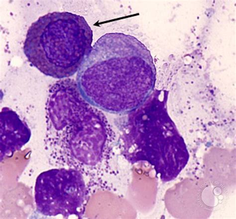 Eosinophilic Myelocyte 1