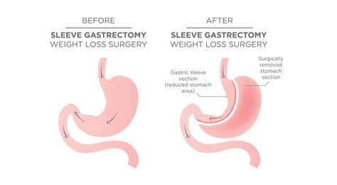 What Is A Sleeve Gastrectomy Winnett Specialist Group