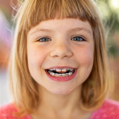Orthodontic Braces For Children Penticton Dental Centre South