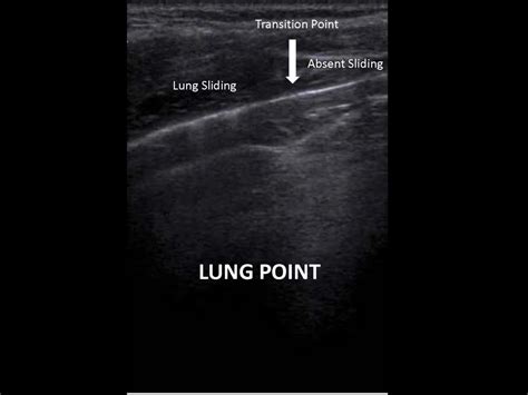 Thoracentesis Pleural Biopsy And Thoracic Ultrasound Pulmonology
