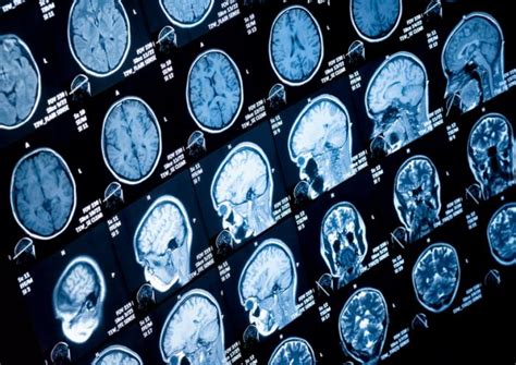 Adhd Large Imaging Study Confirms Differences In Several Brain Regions