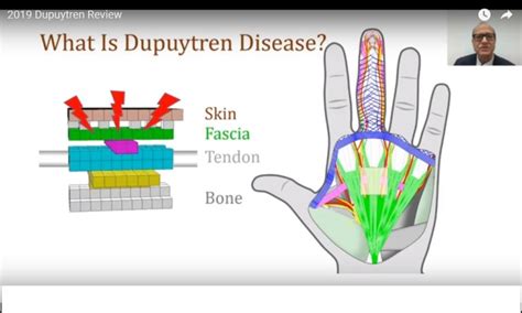 Dupuytrens Disease Simplified —
