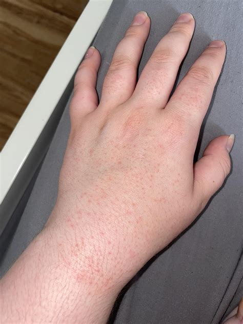 Small Itchy Red Bumps On Back Of Hand Medical