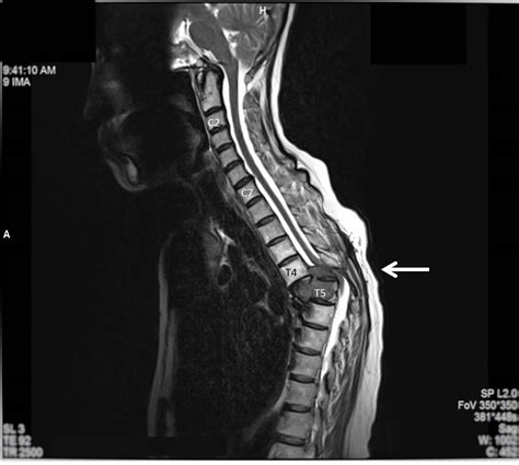 Spinal Cord Compression Hot Sex Picture