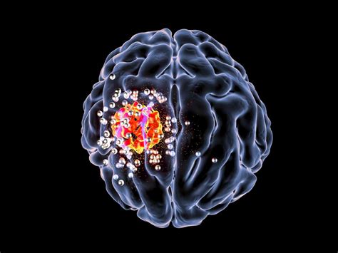 Grade 4 Glioblastoma Brain Cancer Life Expectancy Cancerwalls