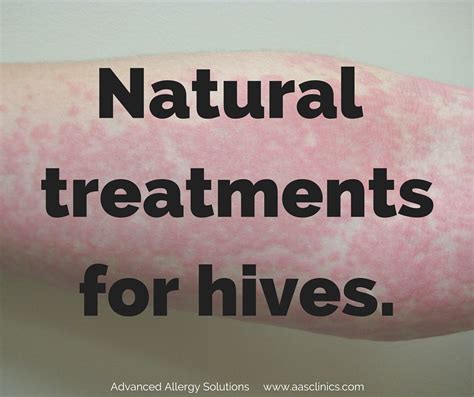 How To Treat Hives Naturally Advanced Allergy Solutions