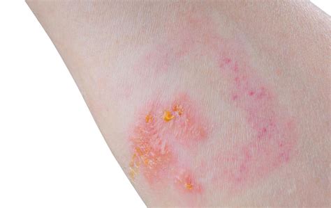 Skin Rash Which Condition Is It Shopping And