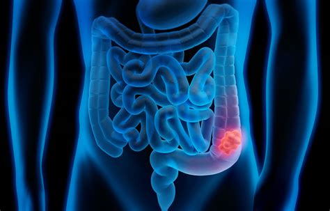 6 Things You Need To Know About Colorectal Cancer Thomson Medical