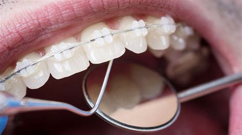 The Importance Of Dental Adhesives In The World Of Orthodontics