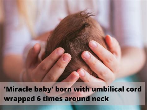Baby With Umbilical Cord Wrapped Around Neck Miracle Baby Born With