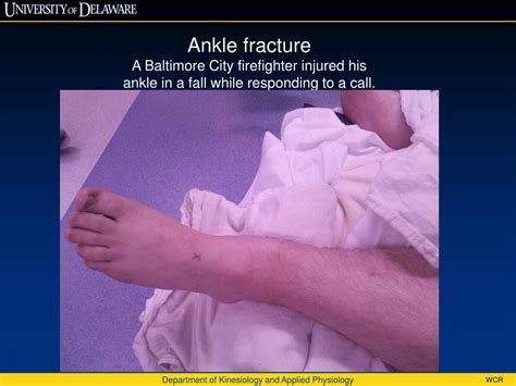 Ppt Ankle Fracture Powerpoint Presentation Free Download Id9581328