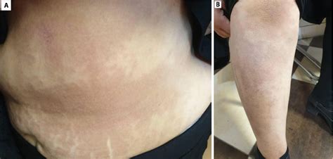 figure 1 from rapid progression of localized morphea to disseminated plaque type morphea