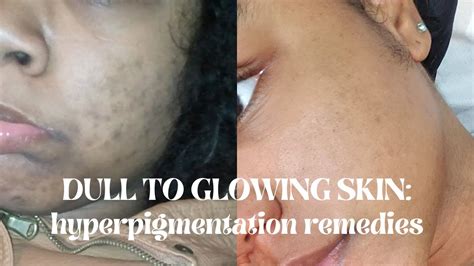Hyperpigmentation Treatment For Black Skin What I Used To Even My